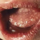 Illustration for article titled Cara Menyembuhkan Penyakit Herpes Zoster